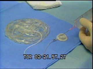 Thumbnail of An Adjustable Breast Implant